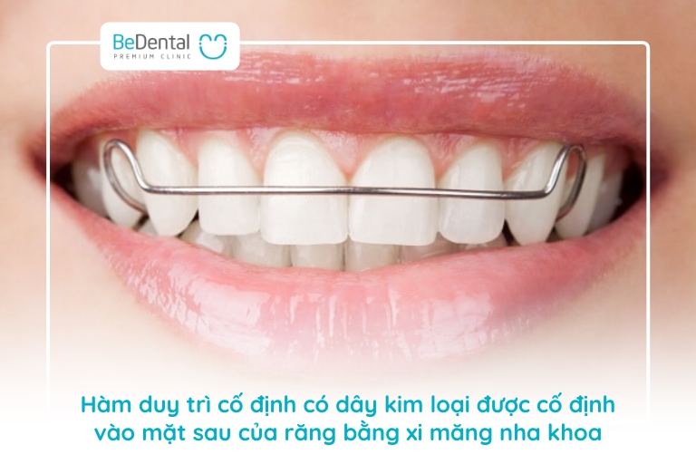 Cách tháo lắp hàm duy trì đảm bảo vệ sinh an toàn 5 Hàm duy trì cố định mang lại hiệu quả hiệu chỉnh rất tốt