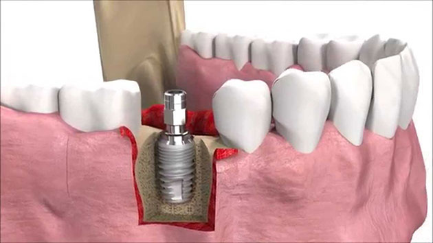 01 Địa chỉ Trồng Răng Implant uy tín giá rẻ tại Quận 1 4