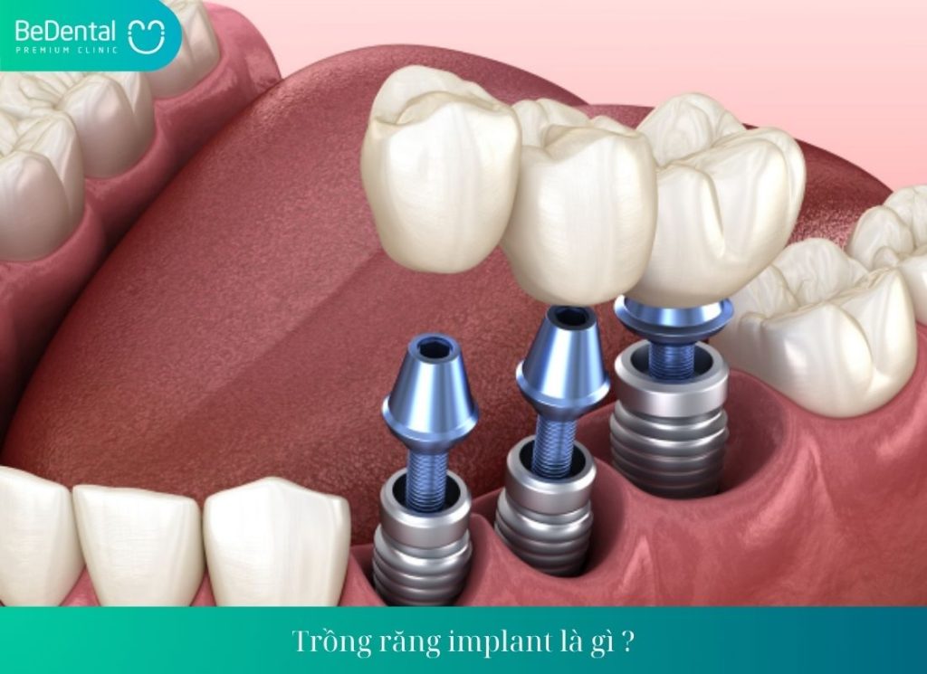 Trồng răng implant là gì