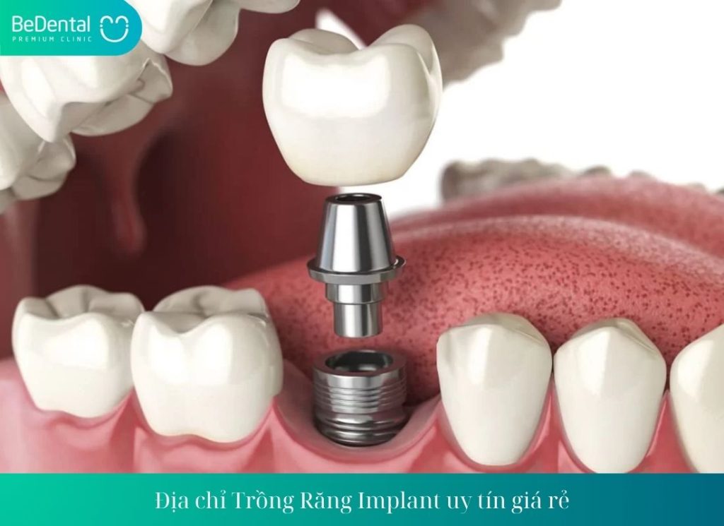 Địa chỉ Trồng Răng Implant 