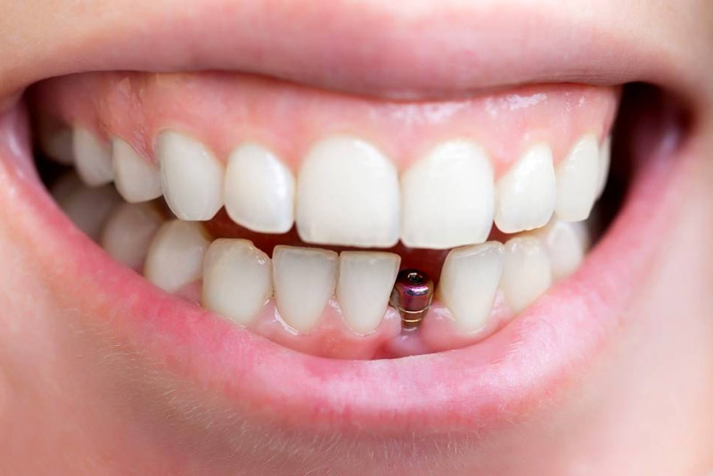 những lưu ý khi trồng răng implant
