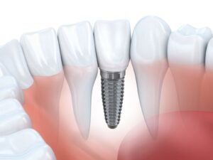 Trồng răng implant bao tiền