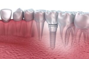 Trồng răng implant bao tiền