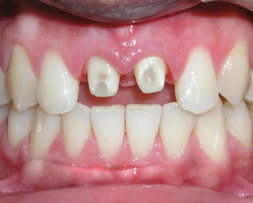 Phục hồi tổn thương trước khi bọc răng sứ