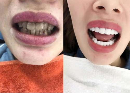 Trước và sau khi bọc răng sứ tại BeDenal