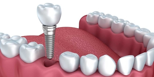Trồng răng implant có đau không? Giá bao nhiêu?