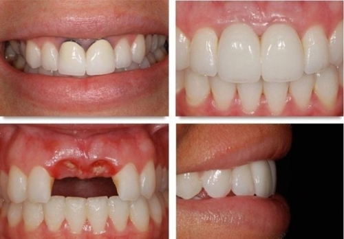 Phương pháp trồng răng implant là phương pháp như nào?