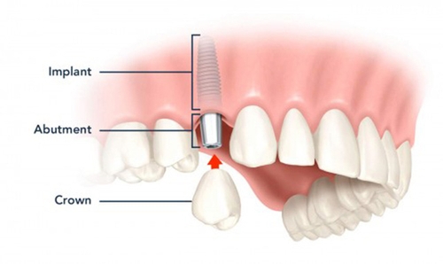 Khi trồng răng implant có đau không?