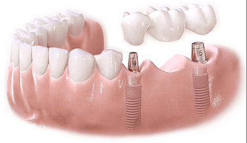 Lắp răng sau khi quá trình cấy trụ titanium phục hồi