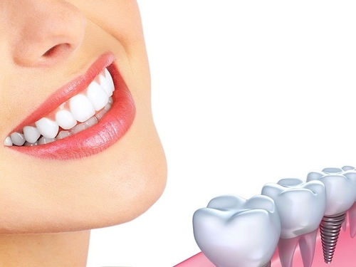 Địa chỉ trồng răng implant chuyên nghiệp chất lượng