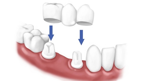 bọc răng sứ hay trồng răng implant sẽ tốt hơn 1