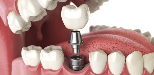 bọc răng sứ hay trồng răng implant sẽ tốt hơn 3
