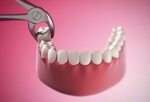 Nhổ răng khôn có ảnh hưởng đến sức khỏe không 1