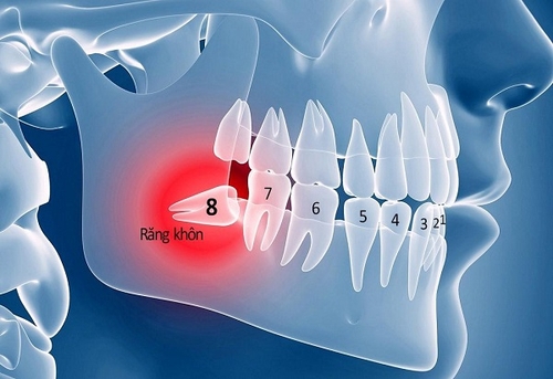 Nhổ răng khôn có ảnh hưởng đến sức khỏe không 