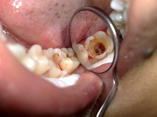 Nhổ răng khôn có ảnh hưởng đến sức khỏe không 4