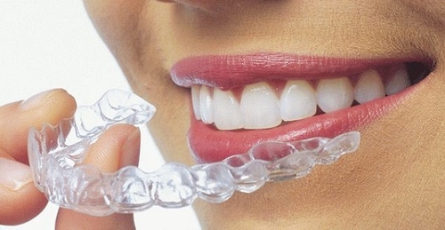 Niềng răng trong bao lâu để đẹp nhất?
