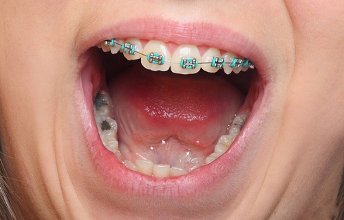 Niềng răng trong bao lâu để đẹp nhất?