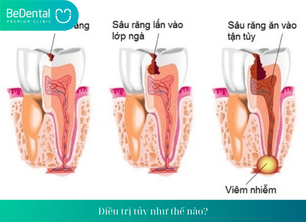 Điều trị tủy như thế nào?Khi nào cần điều trị tủy