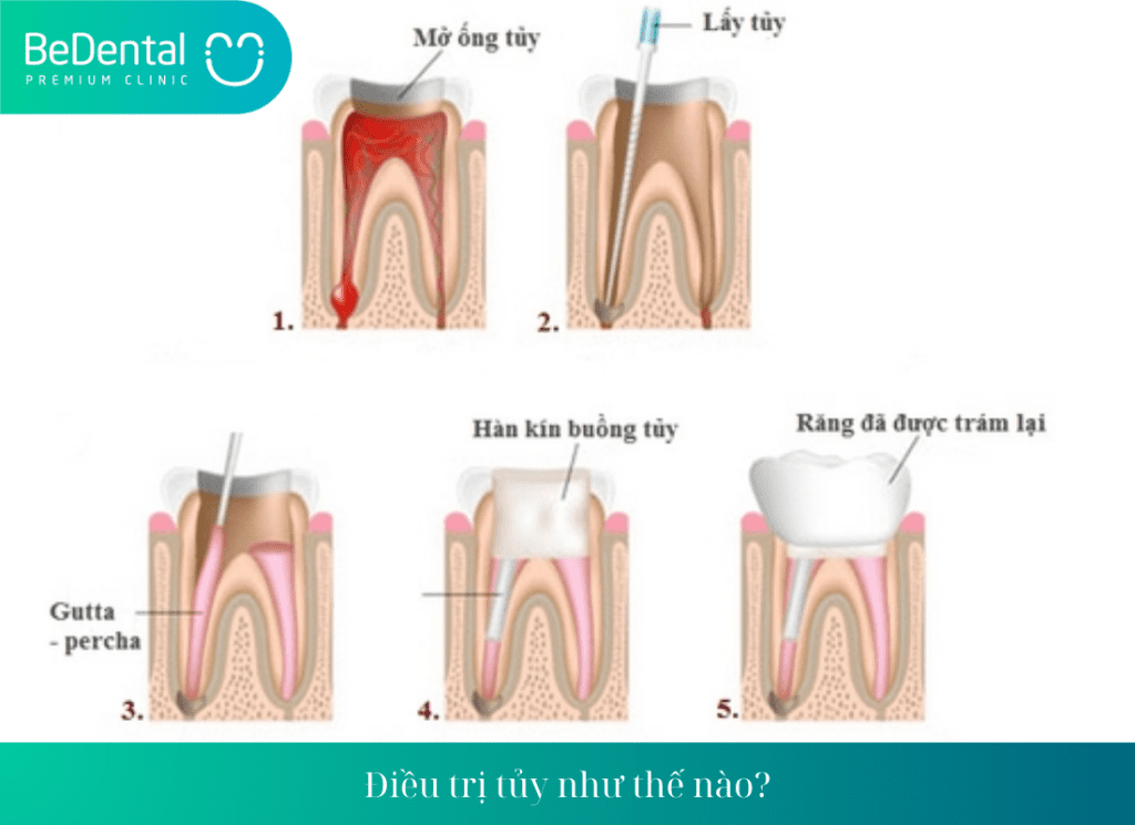 Điều trị tủy như thế nào?Khi nào cần điều trị tủy