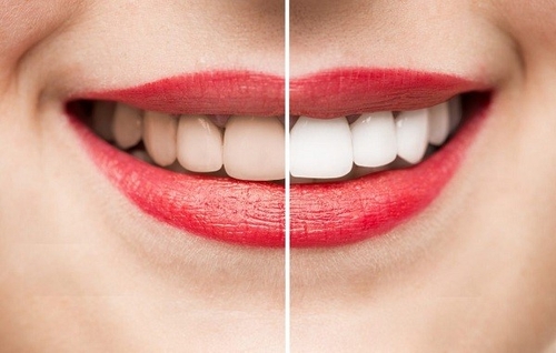 Tẩy trắng răng giá bao nhiêu tiền - Be Dental