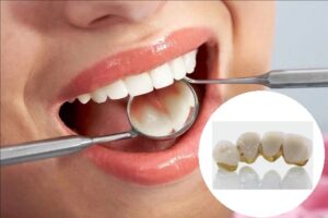 Vậy đâu là yếu tố quyết định độ bền của răng sứ?