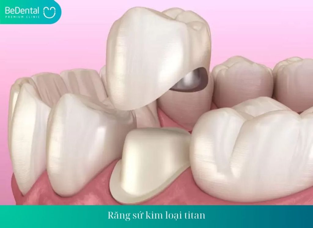 Răng sứ kim loại titan