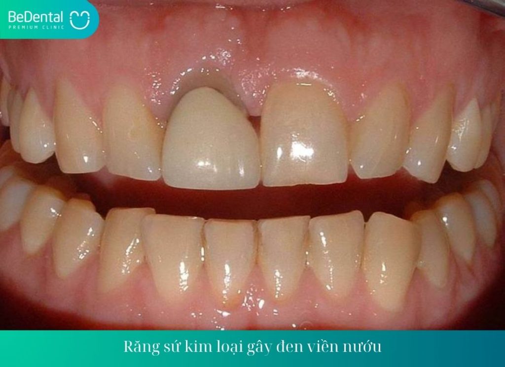 Răng sứ kim loại gây đen viền nướu