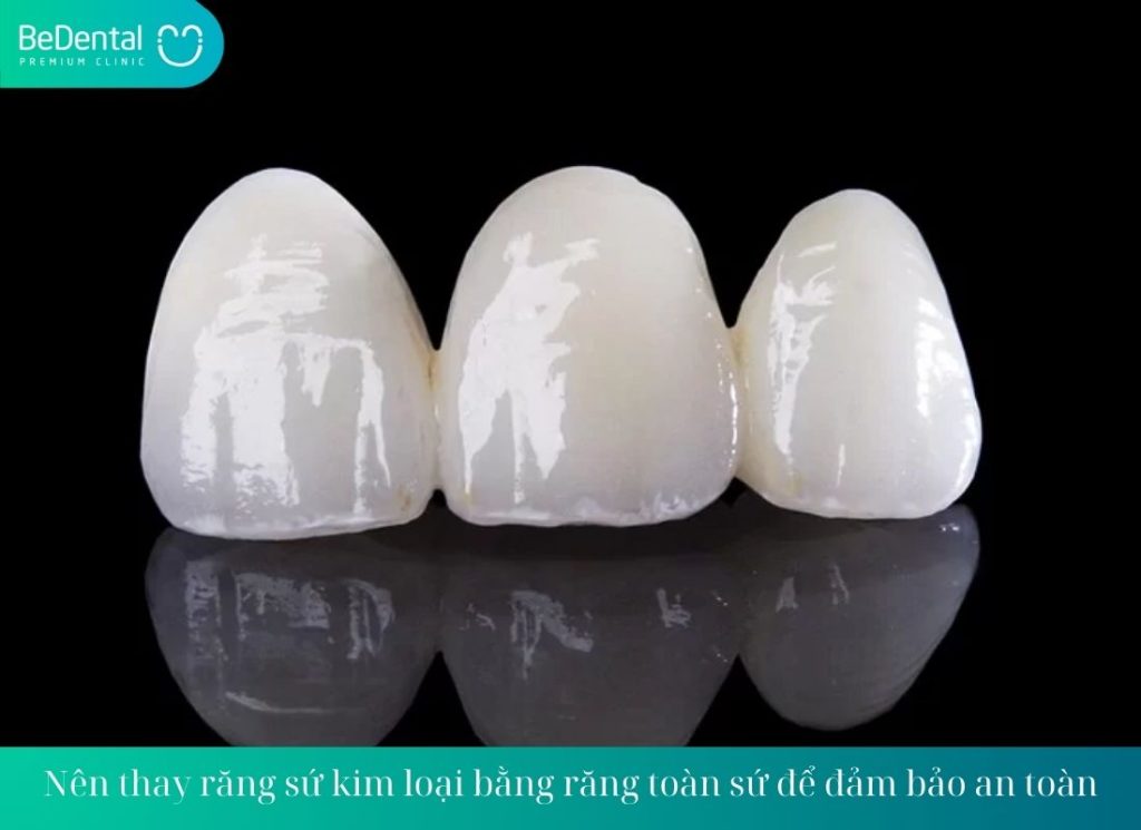 Nên thay răng sứ kim loại bằng răng toàn sứ để đảm bảo an toàn