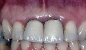 răng sứ kim loại gây đen viền nướu