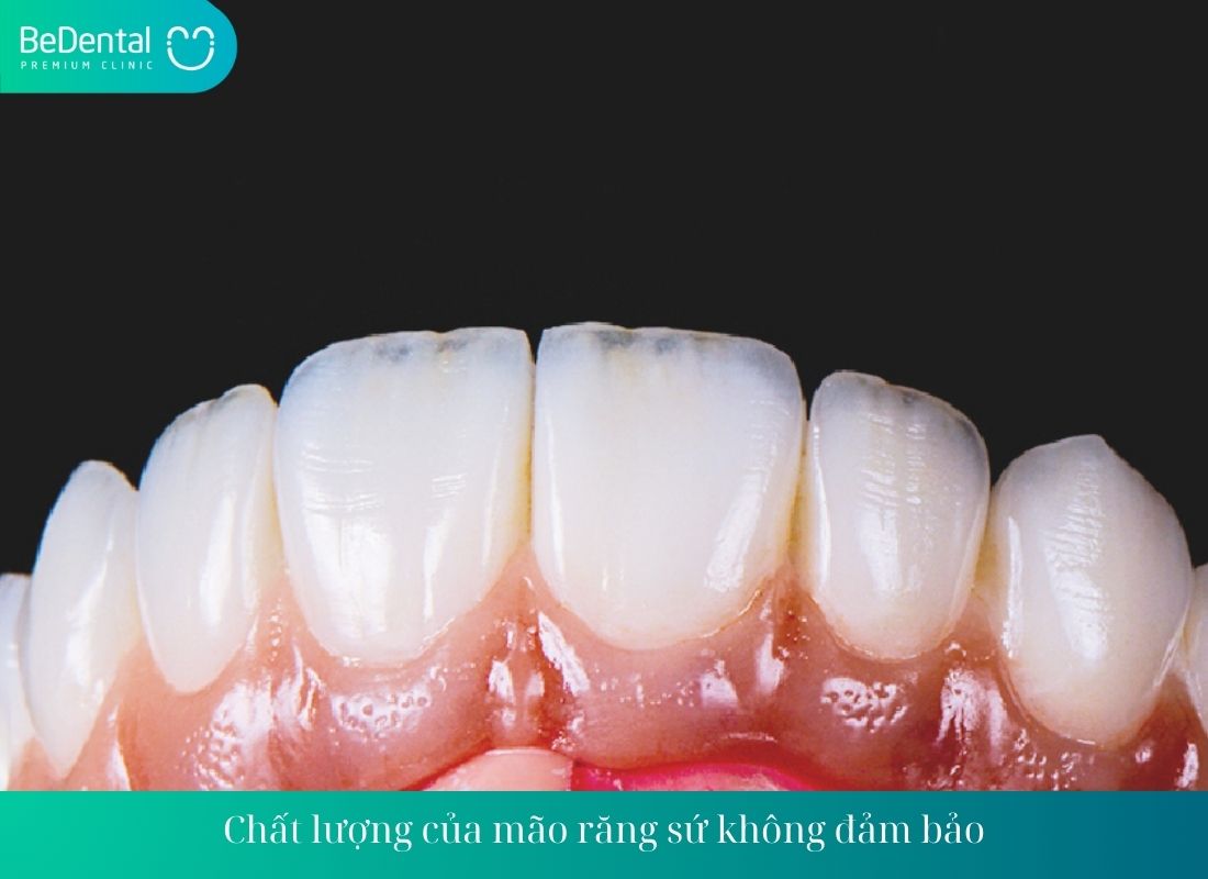 Chất lượng của mão răng sứ không đảm bảo