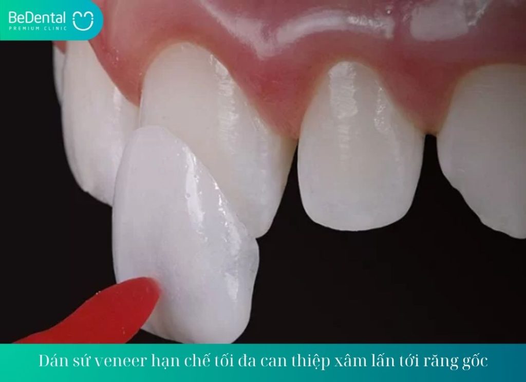 Dán sứ veneer hạn chế tối đa can thiệp xâm lấn tới răng gốc