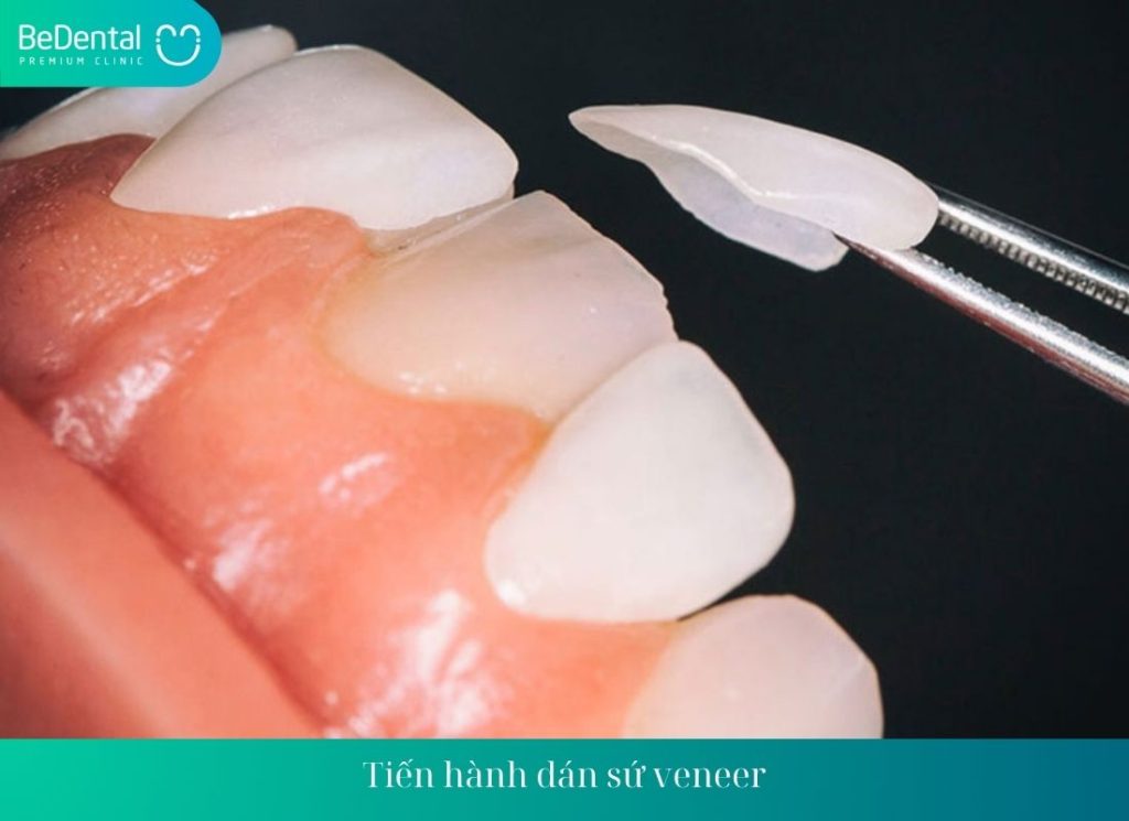 Tiến hành dán sứ veneer