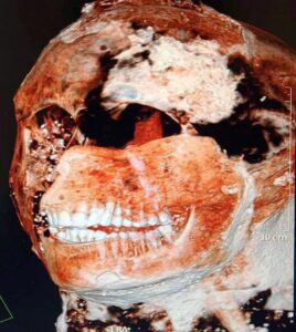 Bộ răng trắng sáng chắc khỏe của người La mã cổ đại sau 2000 năm
