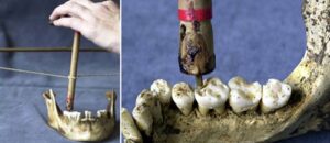Dụng cụ điều trị tủy răng người cổ đại