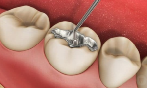 Thành phần vật liệu hàn răng thẩm mỹ làm từ amalgam có chứa 50% từ thủy ngân