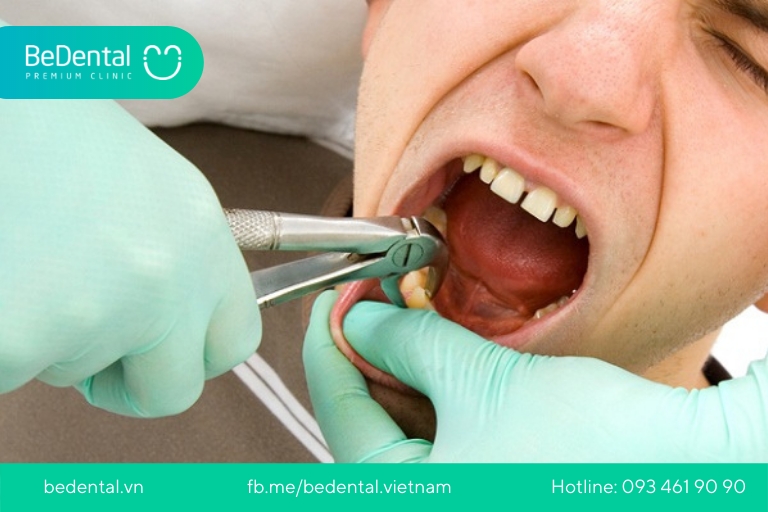 Nhổ răng khôn là điều cần thiết để tránh những rủi ro bệnh lý răng miệng gây ra