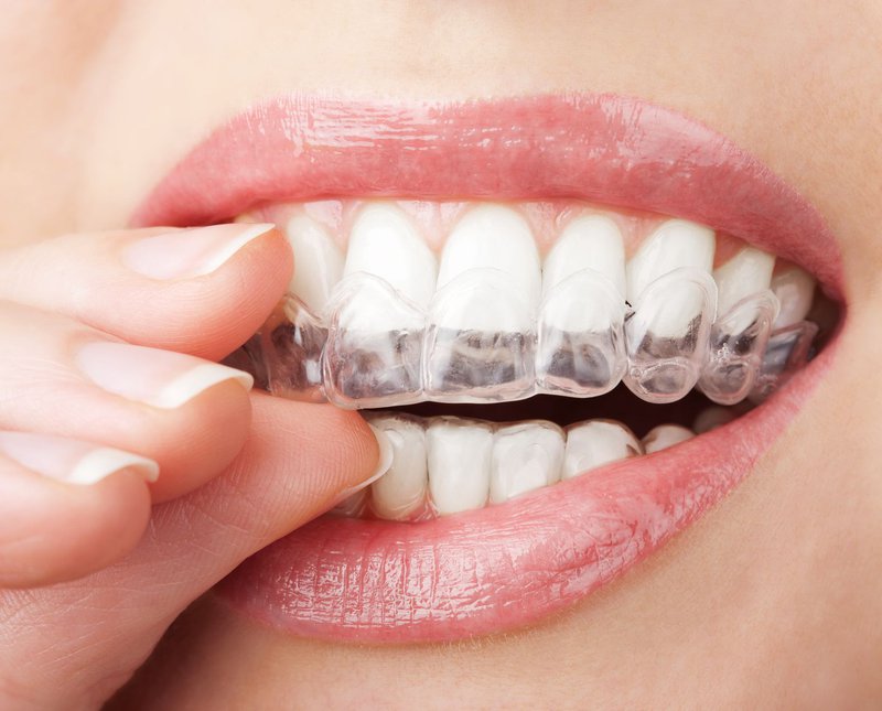 Retainers in Vietnam. Retainers in Vietnam. Retainers in Vietnam. Retainers in Vietnam. Retainers in Vietnam