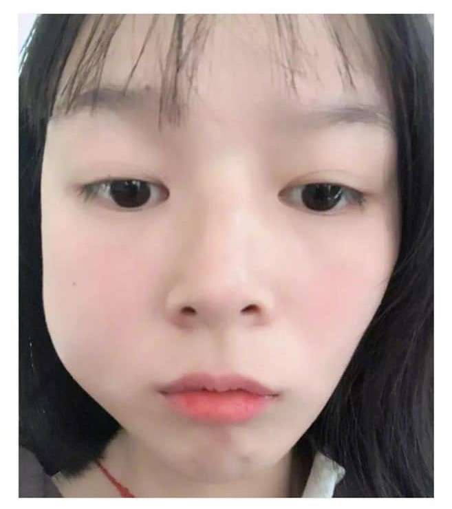 Sưng bọng răng là gì?