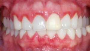 viêm lợi do bọc răng sứ