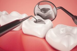 Cách điều trị răng mòn mặt nhai