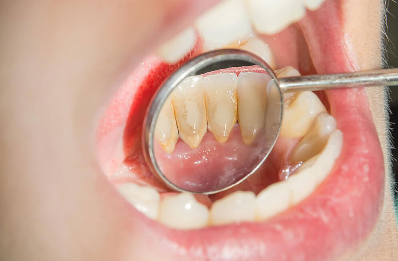 Cạo lấy vôi răng có đau không? Có tốt không hay bị tổn hại men răng? Nên đi  lấy cao răng bao lâu 1 lần – Be Dental