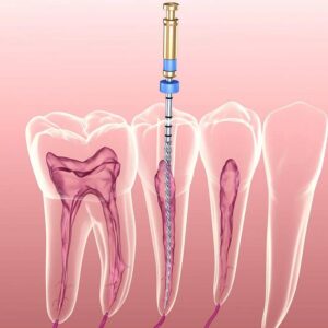 Sâu răng ăn vào tủy dẫn đến phải điều trị tủy