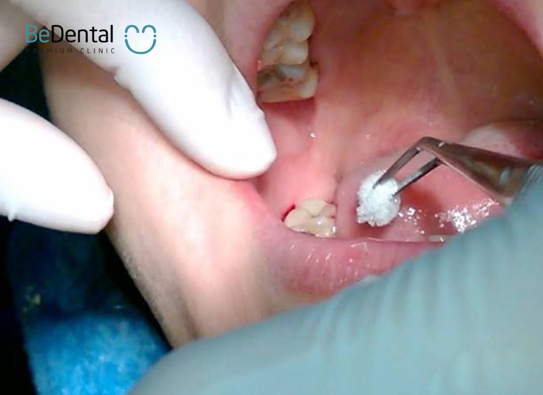 Mọc răng khôn đau mấy ngày? 4 Mọc răng khôn đau mấy ngày?