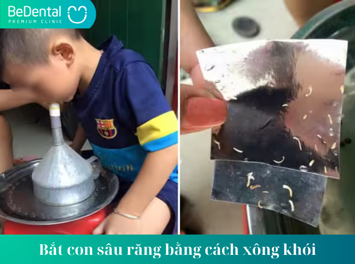 Bắt con sâu răng bằng cách xông khói