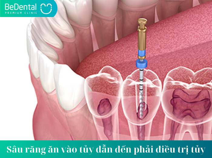 Sâu răng ăn vào tủy dẫn đến phải điều trị tủy