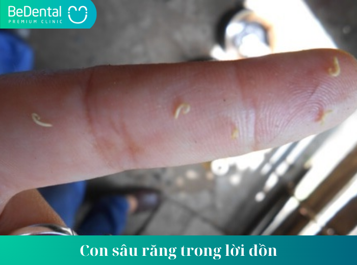 con sâu răng trong lời đồn