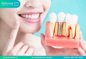 TRỒNG RĂNG IMPLANT TRẢ GÓP THỦ TỤC ĐƠN GIẢN VỚI NHIỀU ƯU ĐÃI 5 trồng răng implant trả góp