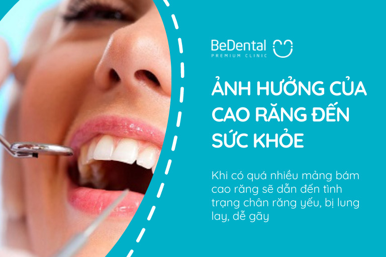 Ảnh hưởng của cao răng đến sức khỏe