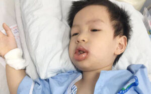 Bùi Bảo Minh 4 tuổi vừa trải qua quá trình gây mê điều trị vì sự chủ quan trong chăm sóc răng miệng