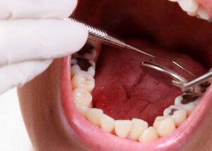 bọc sứ cho răng hàm